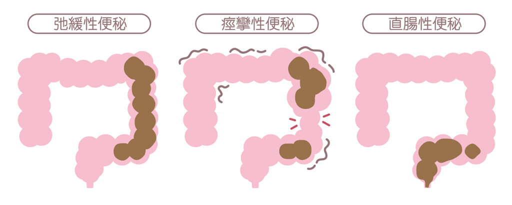 「機能性便秘」のイメージ
